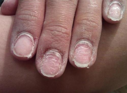 Уникнути багатьох проблем після нарощування нігтів ви зможете, якщо будете враховувати існуючі протипоказання до цієї процедури