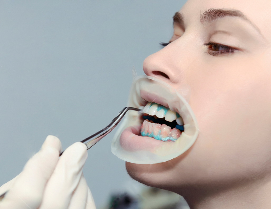 Якщо виконується відбілювання зубів Zoom 4, то це гель з вмістом перекису водню 25%